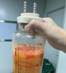 菏泽水动力吸脂手术要做多久？